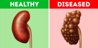 5 Common Habits That Could-Be-Damaging Your Kidneys