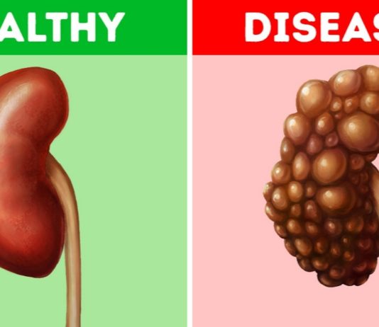 5 Common Habits That Could-Be-Damaging Your Kidneys