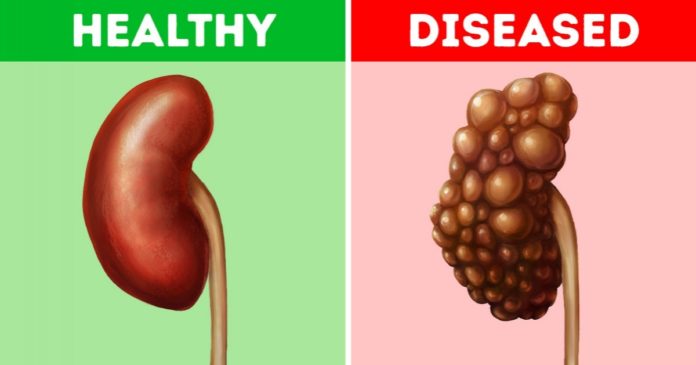 5 Common Habits That Could-Be-Damaging Your Kidneys