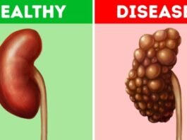 5 Common Habits That Could-Be-Damaging Your Kidneys