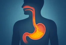 Medical illustration of GERD showing chronic acid reflux damaging the esophagus.